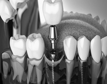 257-2574129_dental-implant-3