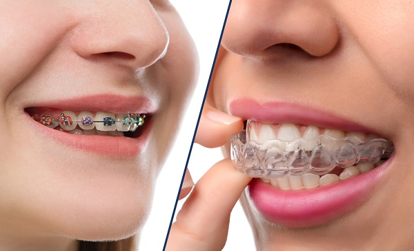 braces-vs-invisalign-hero-1